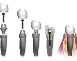 Ma cosa è un impianto ?