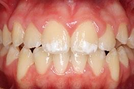 Composizione dello smalto dei denti