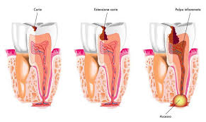 La devitalizzazione del dente