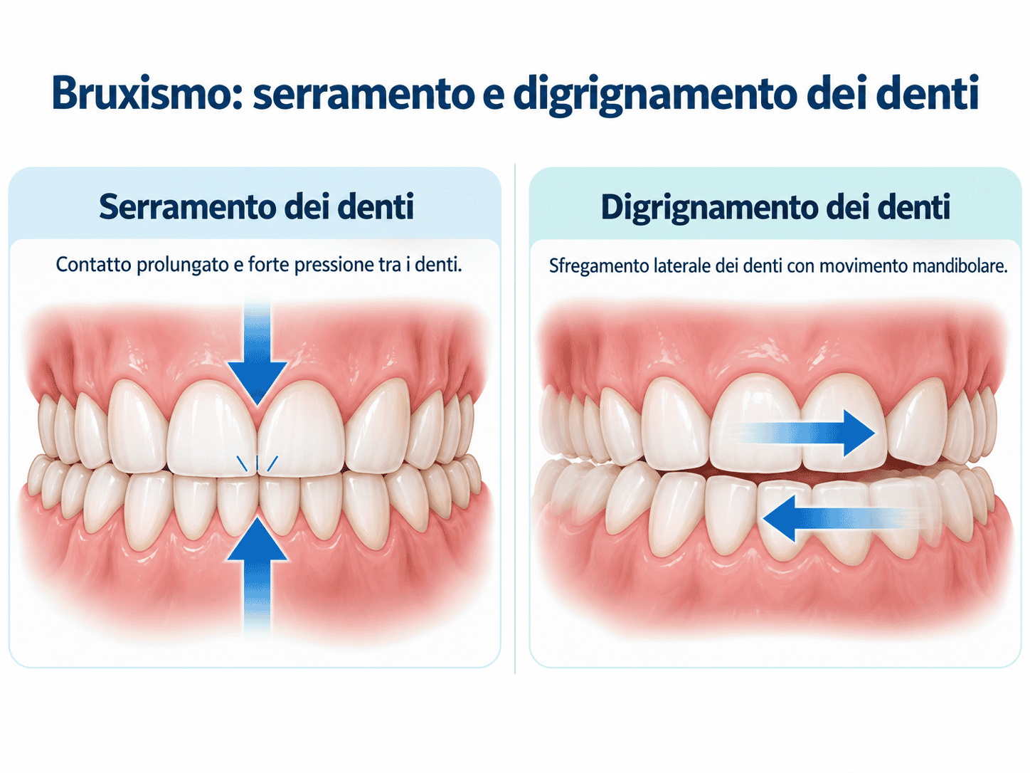Schema del bruxismo con serramento e digrignamento dei denti