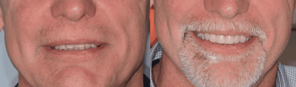 Prima e dopo trattamento con Injection Technique in composito sui denti anteriori