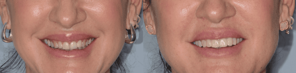 Prima e dopo trattamento additivo con Injection Technique sui denti anteriori