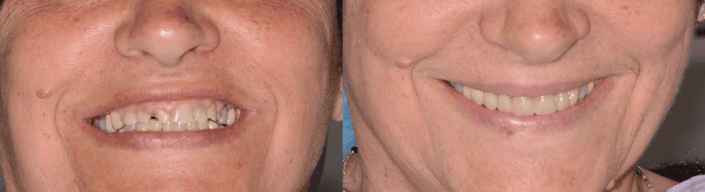 Confronto prima e dopo trattamento con Injection Technique in composito
