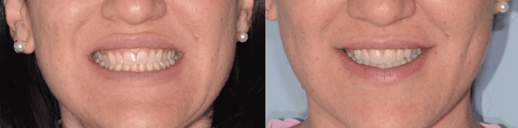 Injection Technique per il recupero Prima e dopo Injection Technique per il recupero estetico dei denti anteriori