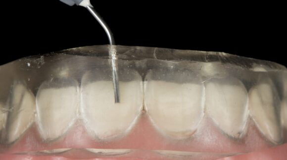 Matrice trasparente per Injection Technique con iniezione di composito sui denti anteriori