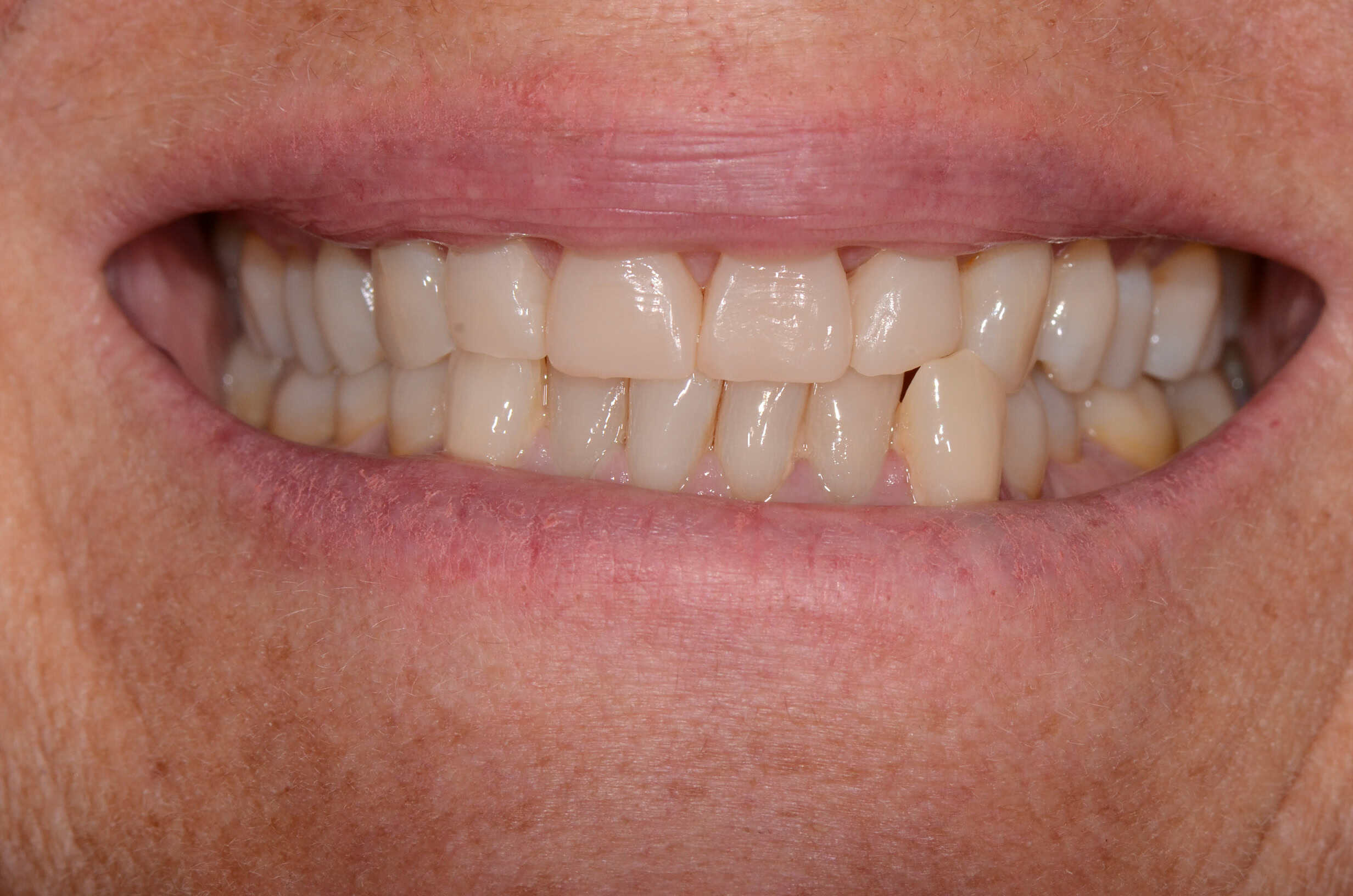 Risultato estetico dopo trattamento con Injection Technique in composito
