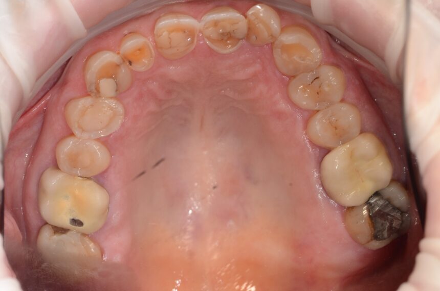 Usura dentale diffusa vista occlusale dell'arcata superiore